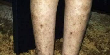 Dépigmentation artificielle volontaire de la peau : Un danger pour la santé.