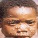 Variole du Singe. Les Comores au bord de la faille sanitaire ouverte à Majunga.